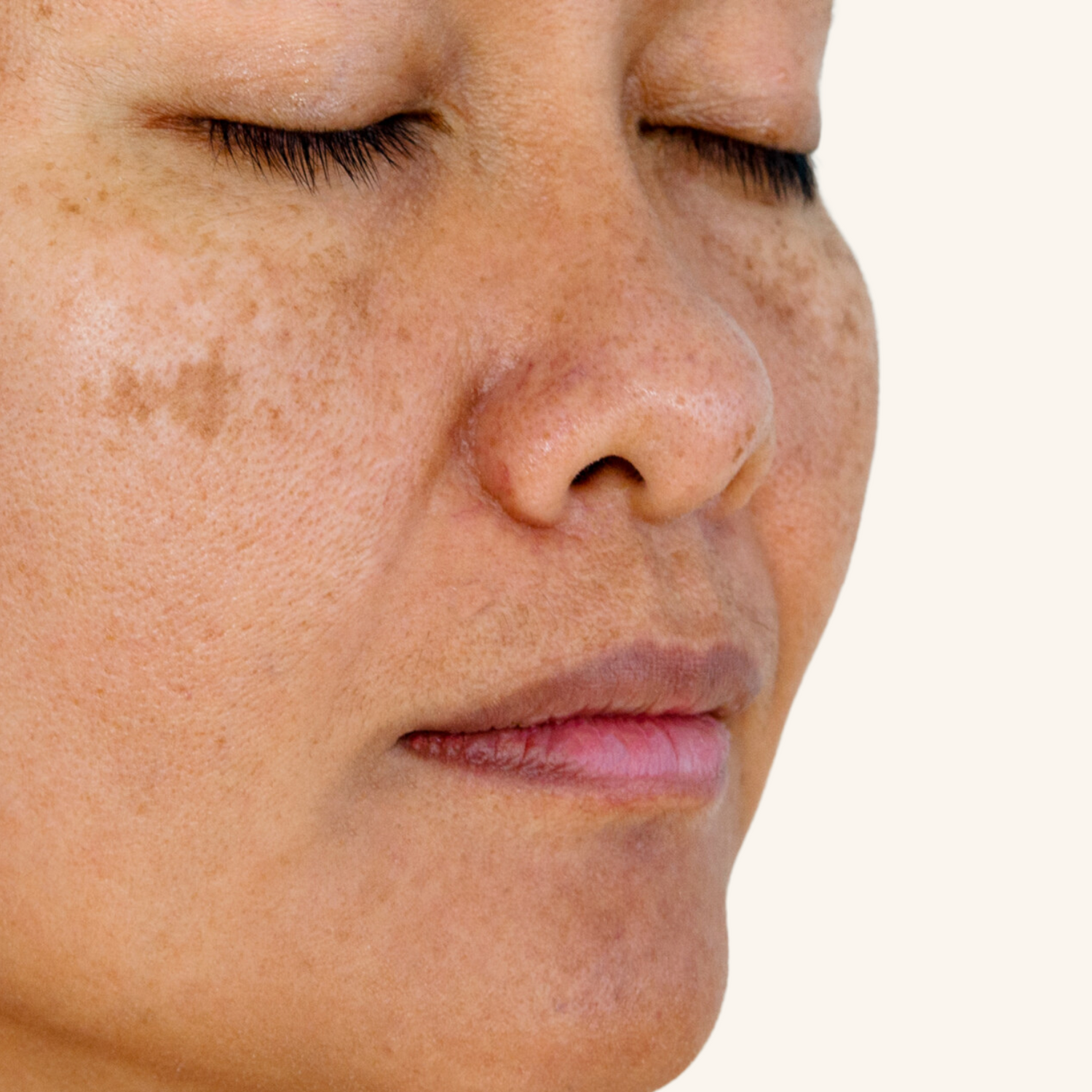 Skin Pigmentation Removal Torquay