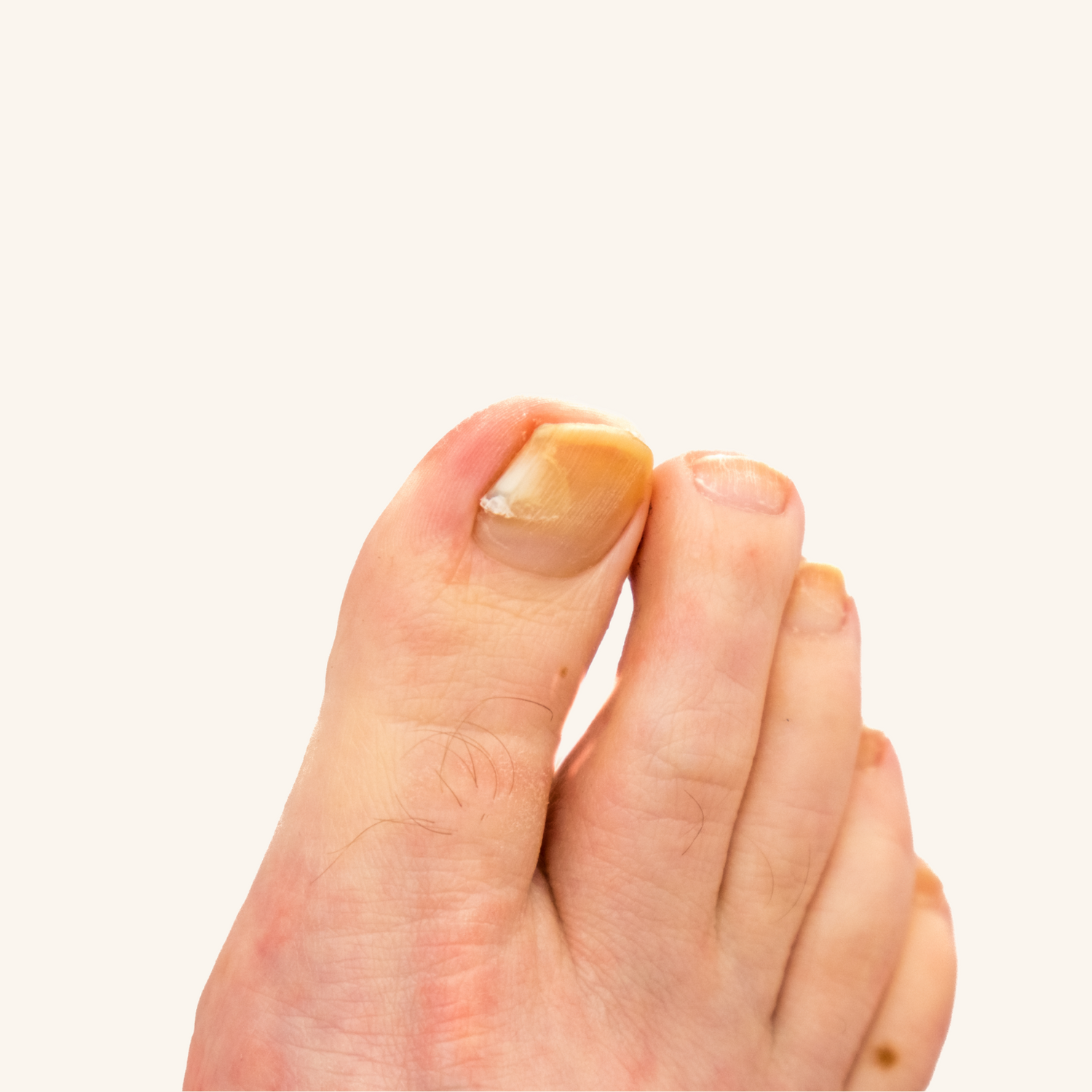 fungal toe nail removal torquay verrucas