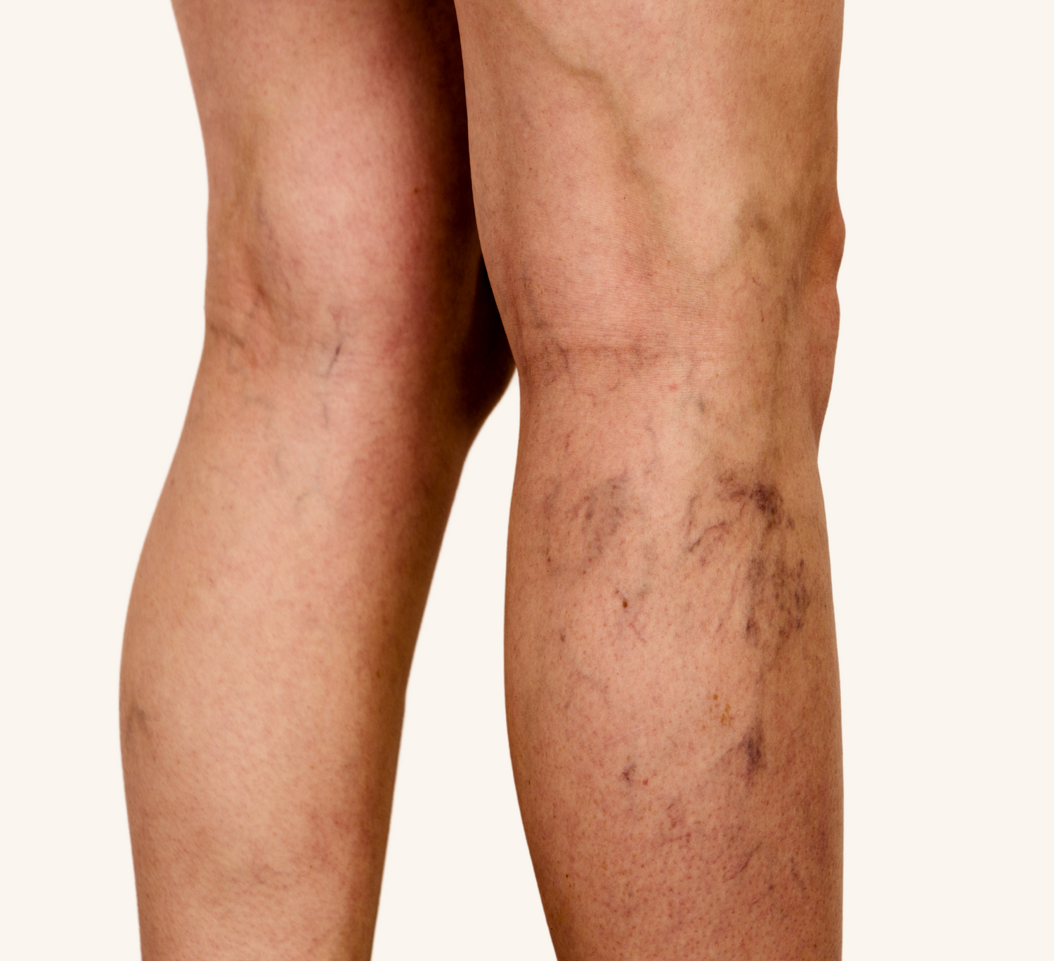 Spider veins leg veins torquay