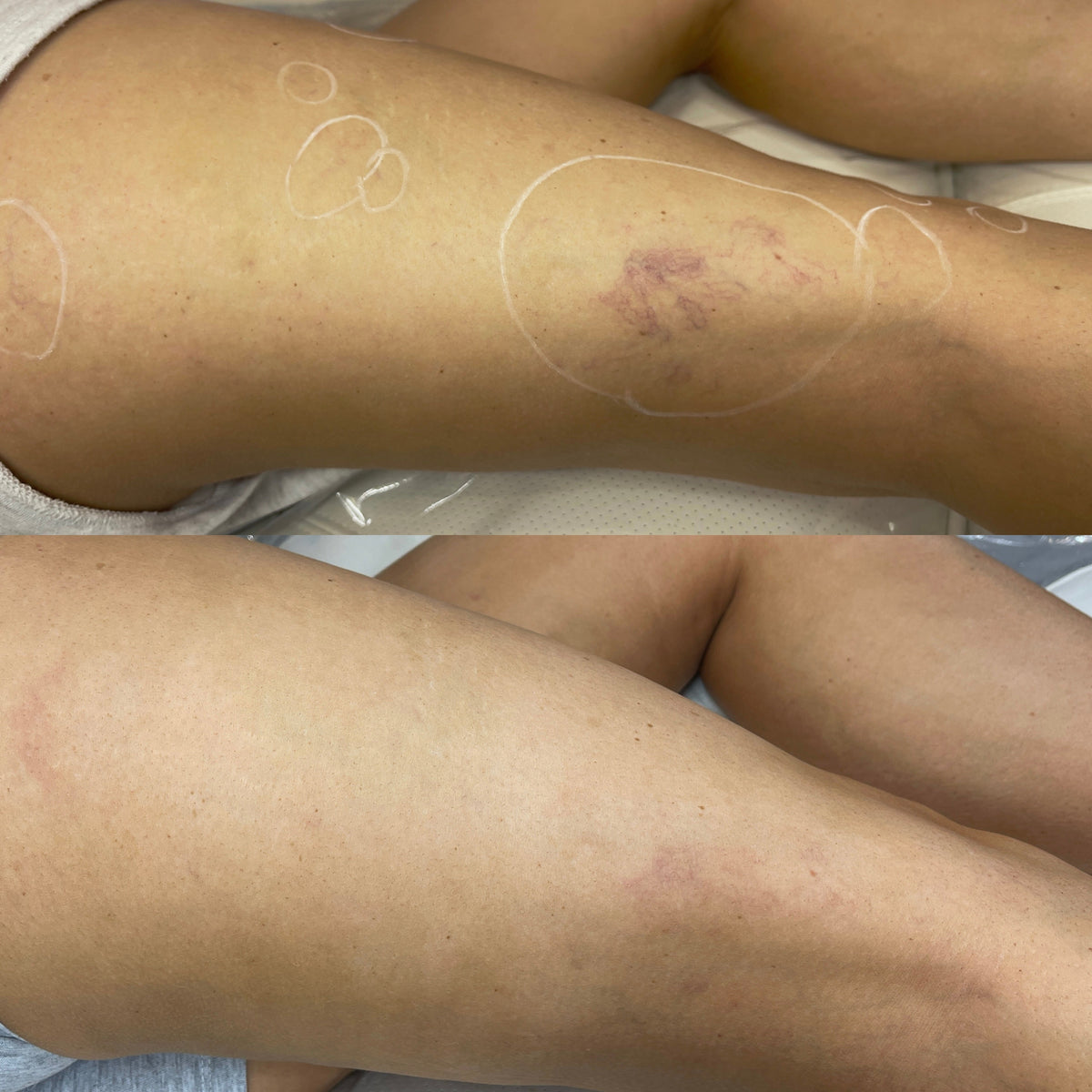 vein removal torquay