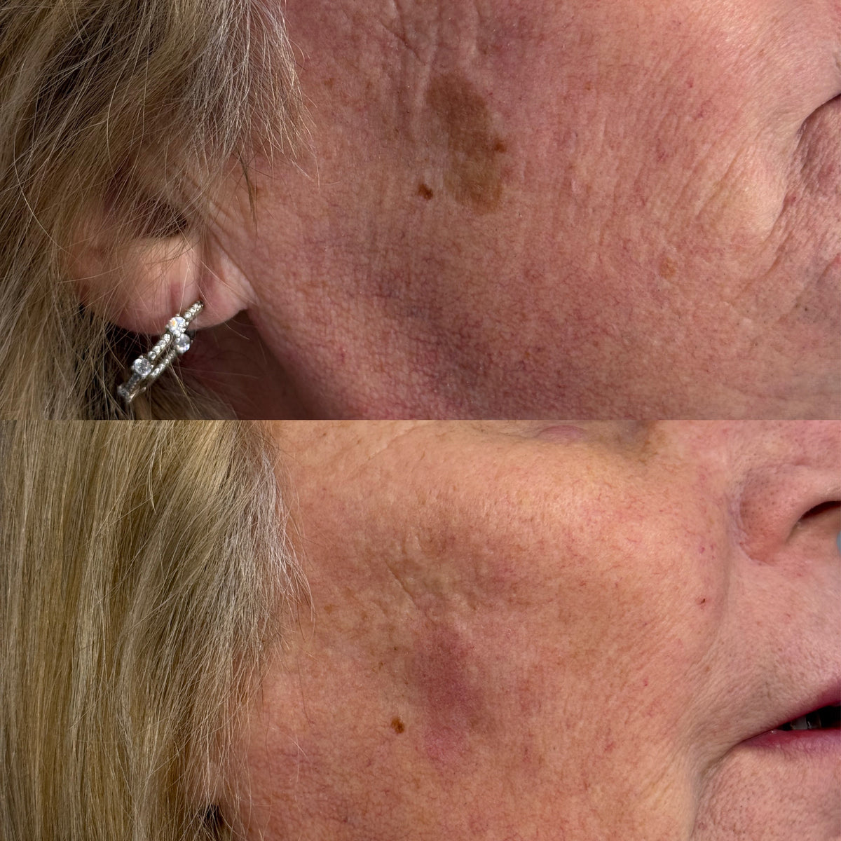 seborrheic keratosis torquay