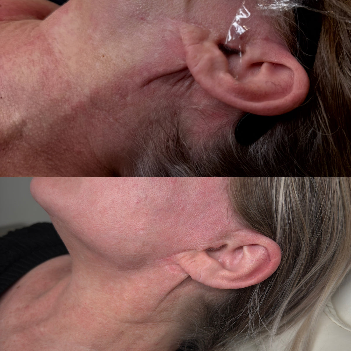 post facelift scar removal