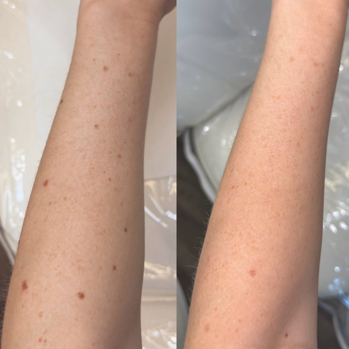 freckle removal